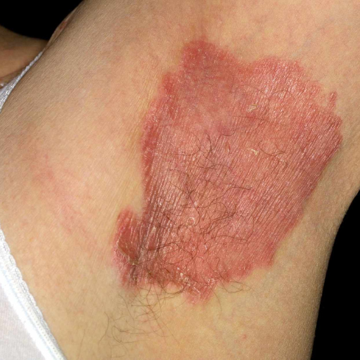 psoriasis