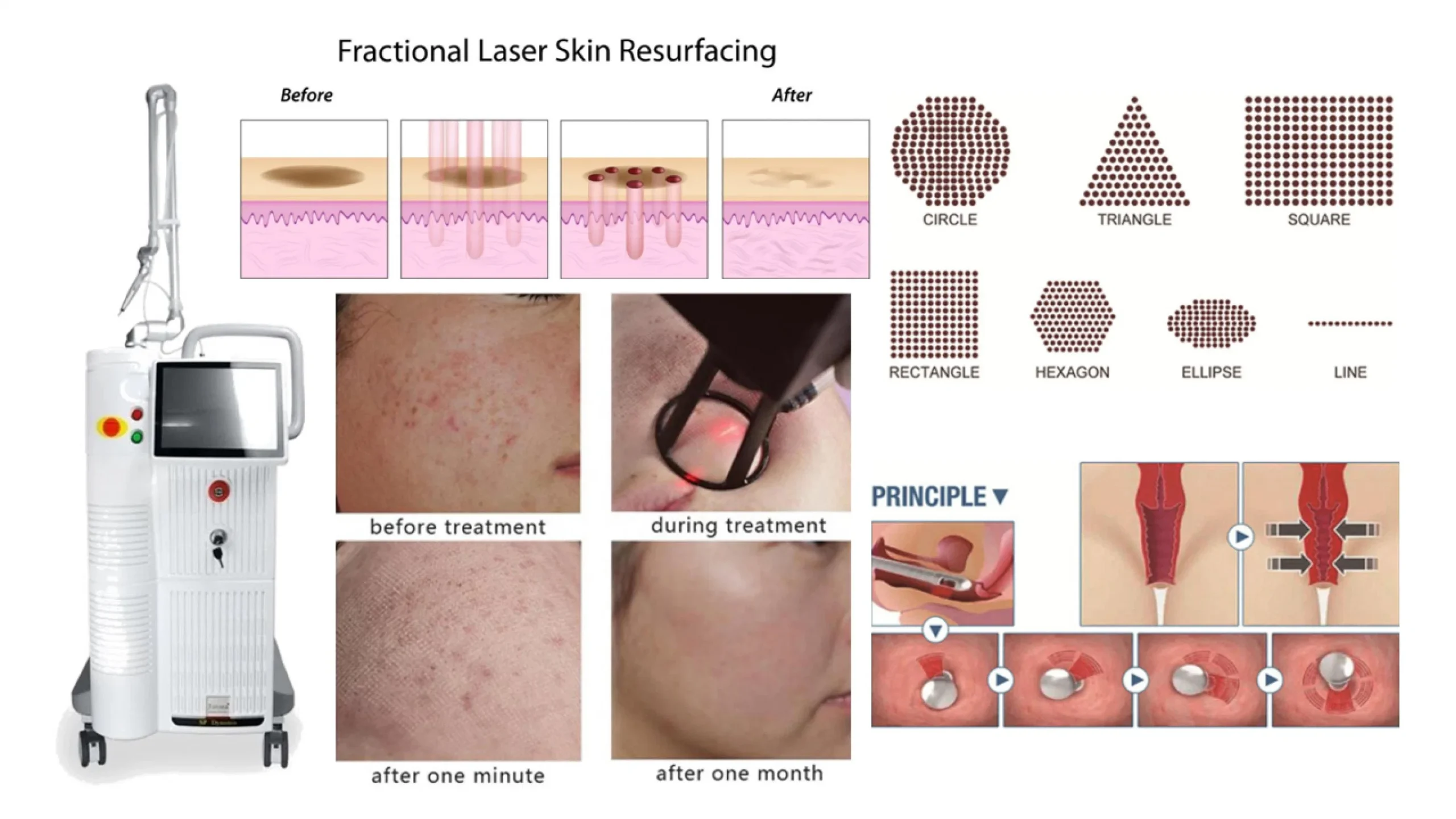 Fractional CO2 Laser For Acne Scars