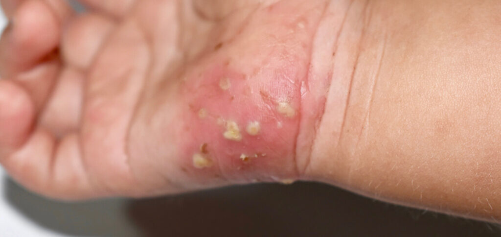 scabies