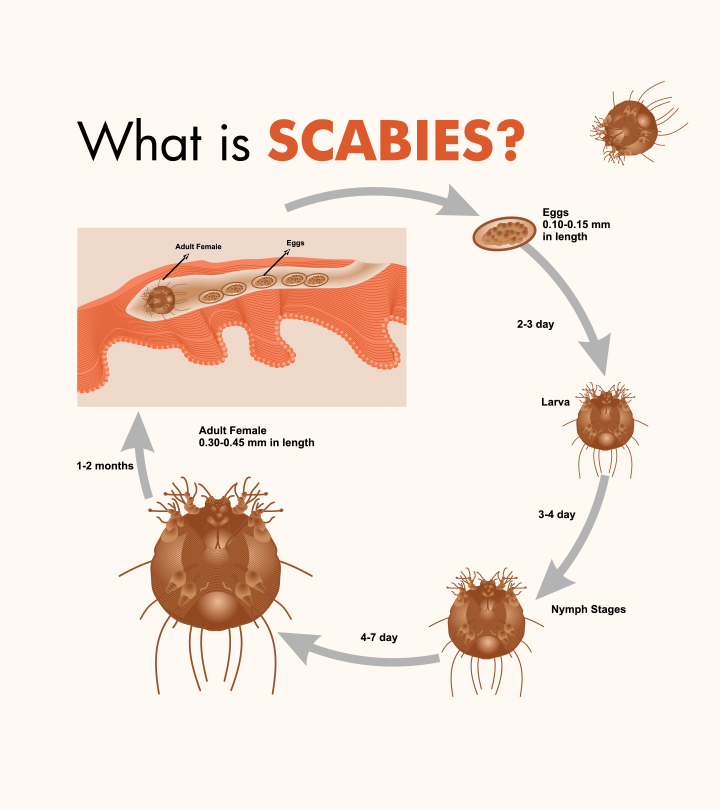 scabies