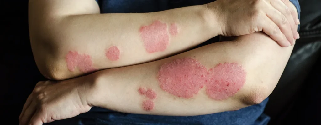 psoriasis