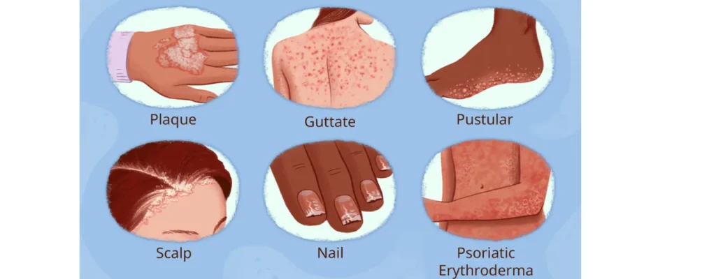 psoriasis