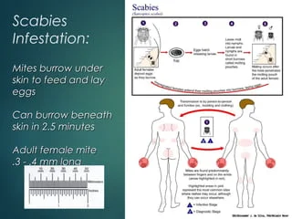 scabies