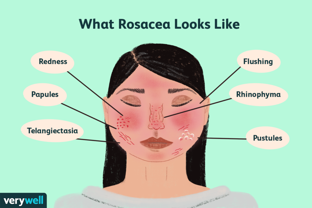 rosacea