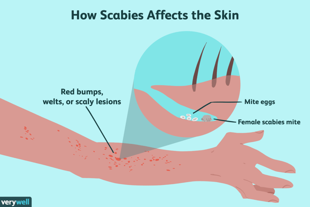 scabies