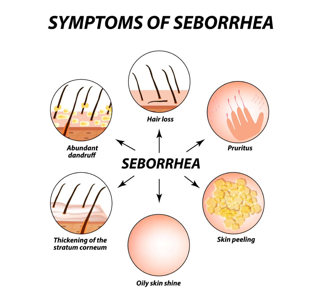 seborrheic eczema