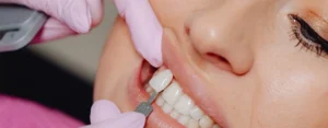 dental veneers