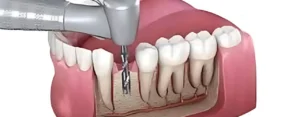 root canal