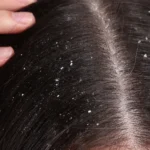 Hair Fall, Dandruff, and Dryness – Euthrix Has Got You Covered